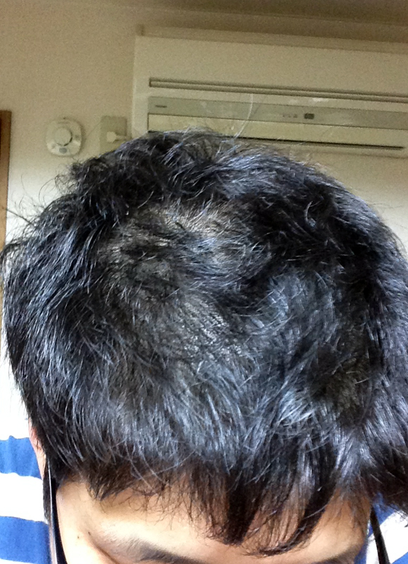 薄毛の憂鬱 頭髪に爆弾を抱えている男性が 自撮り を全く楽しめない5つの理由 ロケットニュース24