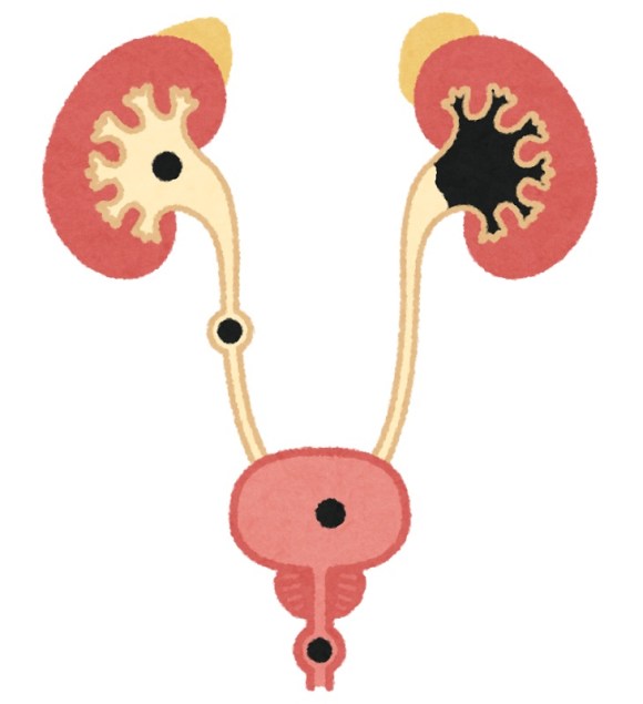 用途不明 有名フリー素材サイト いらすとや ついに 尿路結石 のイラスト化に成功 ロケットニュース24