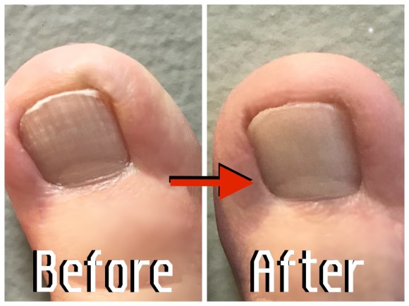 マジメ検証 足爪がデコボコで裸足がイヤ なので 足爪をキレイにするという ザンミーラ ネイル を1ヶ月使ってみた結果 デコボコが 消えた Pouch ポーチ